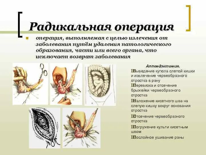 Эта операция является примером. Радикальная операция пример. цель радикальной операции. виды радикальных операций. радикальные хирургические операции.