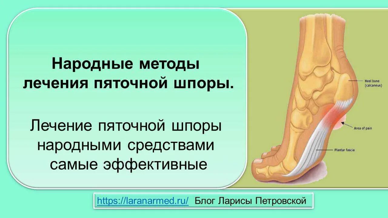 Пяточная шпора лечение у женщин. Пяточная шпора народные. признаки пяточной шпоры. шпора на пятке чем лечить. шпора в пятке как лечить.