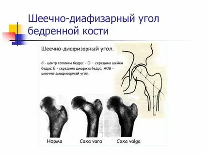 Шеечно диафизарный угол у детей норма таблица