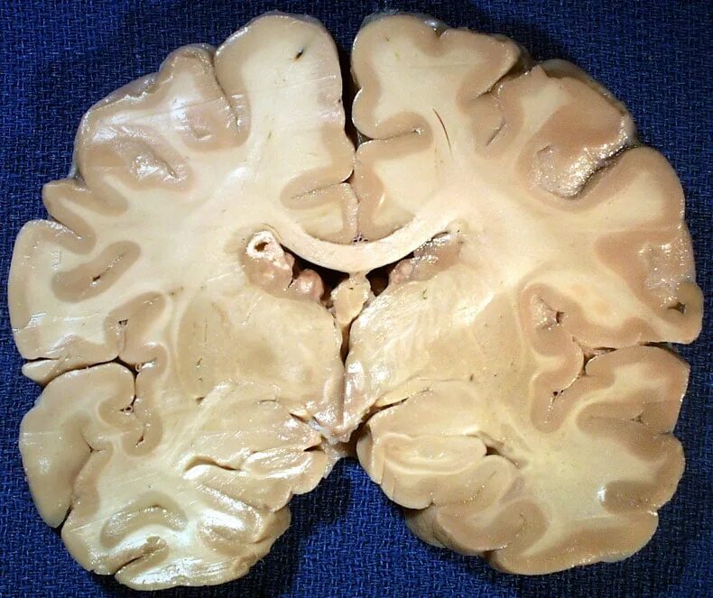 Атрофия головного мозга патанатомия. Туберозный рассеянный склероз. Гидроцефалия головного мозга макропрепарат. Макропрепарат туберозный глиоз.