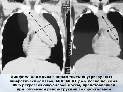 Лимфома операция