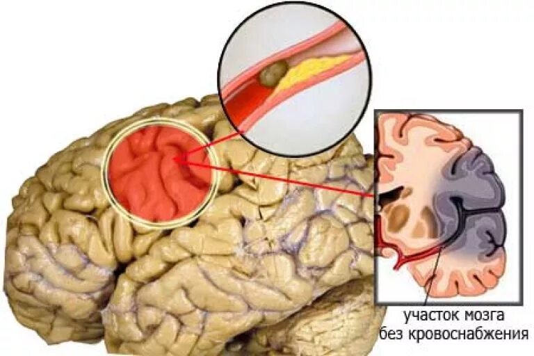 Бляшка в головном мозге. Инсульт ишемический (закупорка сосуда). Ишемический инсульт головного мозга. Ишемия ишемический инсульт мозга. Ишемический инсульт очаг поражения.