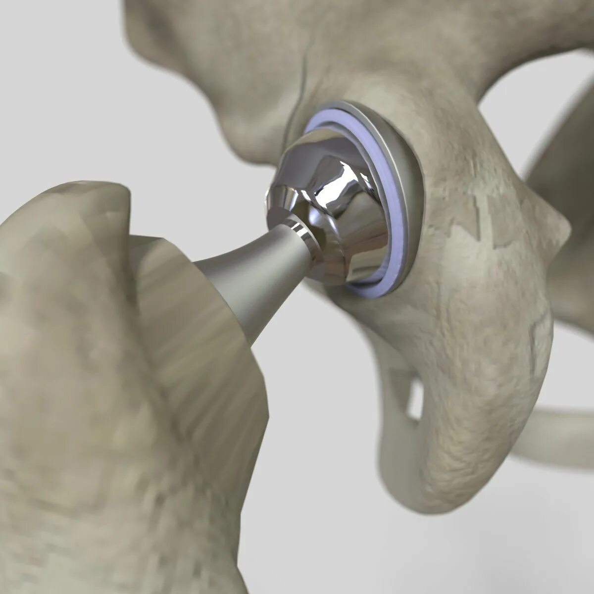 Операция замена сустава бедра. Эндопротезирование тазобедренного сустава операция. Эндопротез тазобедренного сустава Zimmer. Тазобедренный эндопротез Stryker. Эндопротез тазобедренный Титан керамика.