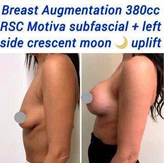 Before and After Breast Lift with Breast Implants or Breast Fat Transfer.