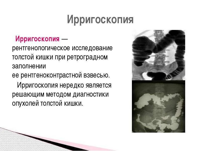 Ирригоскопия выявляет. Рентгенологическое исследование толстого кишечника (ирригоскопия).. ирригоскопия толстого кишечника рентген. ирригоскопия кишечника контрастное вещество. ирригоскопия метод исследования кишечника.