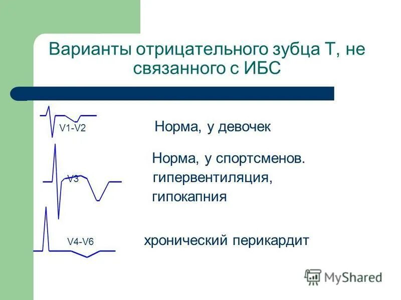 V1 v2 v3 v4. V3 сегмент позвоночной артерии. Qrs на экг в v 1. V1 v2 v3 v4. V3 в английском.