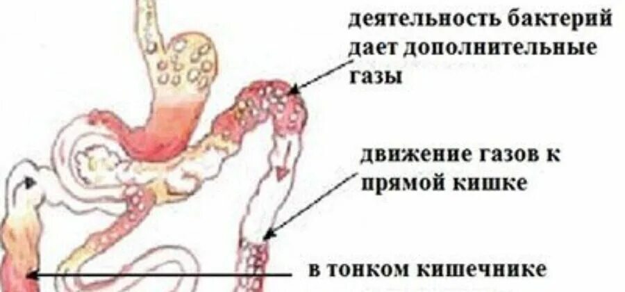 Образование газов в кишечнике.