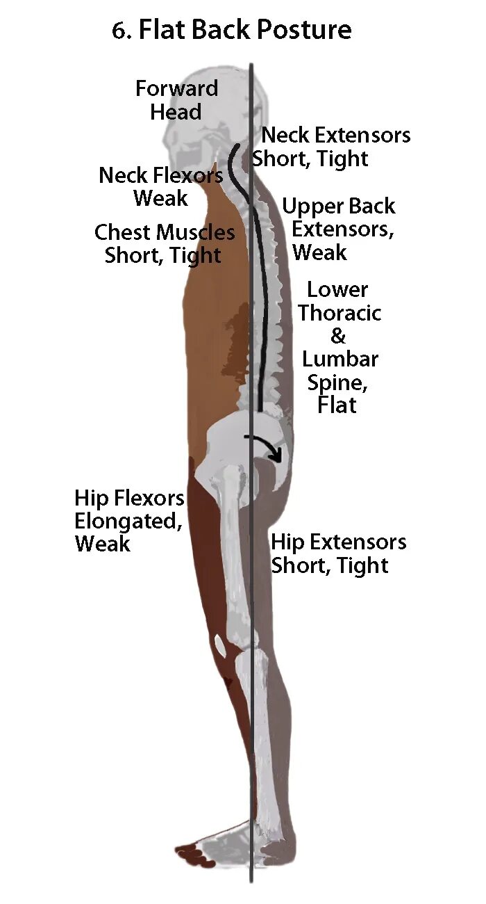 How is your back. Flat back осанка. флэт бэк. флэт бэк назад. flat upper back.