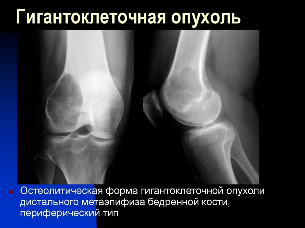 Гигантоклеточная опухоль плечевой кости кт. Опухоли костей лечение. Отек кости лечение. Злокачественные опухоли кости классификация. Отек кости лечение.