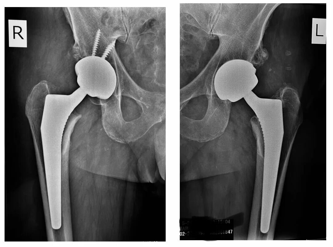 Эндопротезирование тазобедренного сустава рентген. Эндопротез тазобедренного сустава рентген. Рентген эндопротеза тазобедренного сустава. Эндопротез плечевого сустава рентген. Эндопротезирование тазобедренного отзывы пациентов