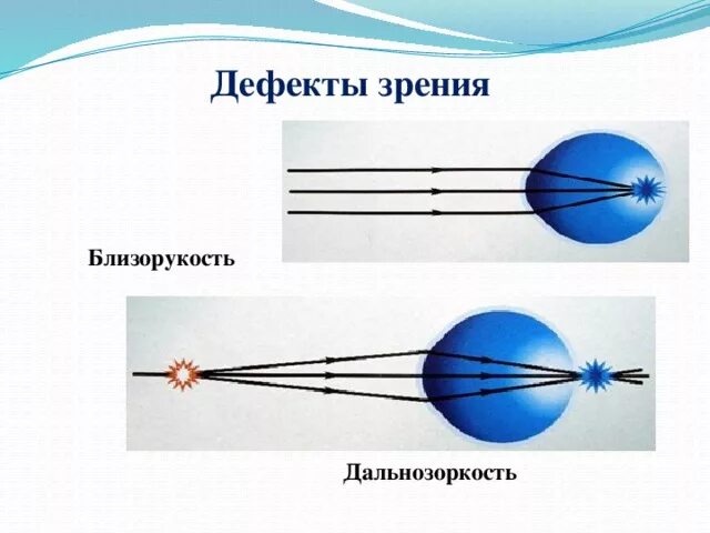 Дефекты зрения ответы. Дальнозоркость и близорукость строение глаза. Дефекты зрения дальнозоркость физика. Дефекты зрения близорукость и дальнозоркость. Глаз близорукость и дальнозоркость физика.