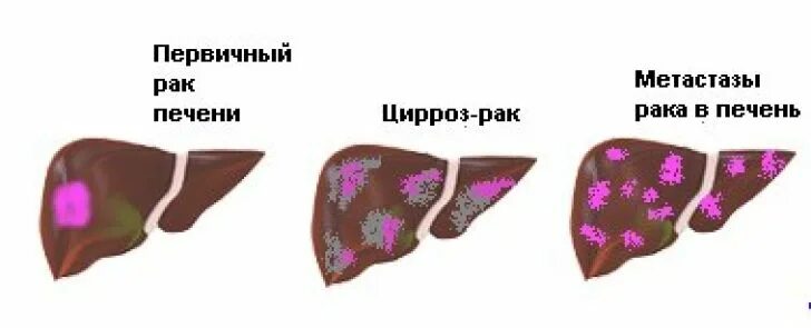 Рак печени 4 стадии сколько живут. Первичная карцинома печени. Цирроза печень опухоли печени. Злокачественные поражения печени. Объемные образования печени.