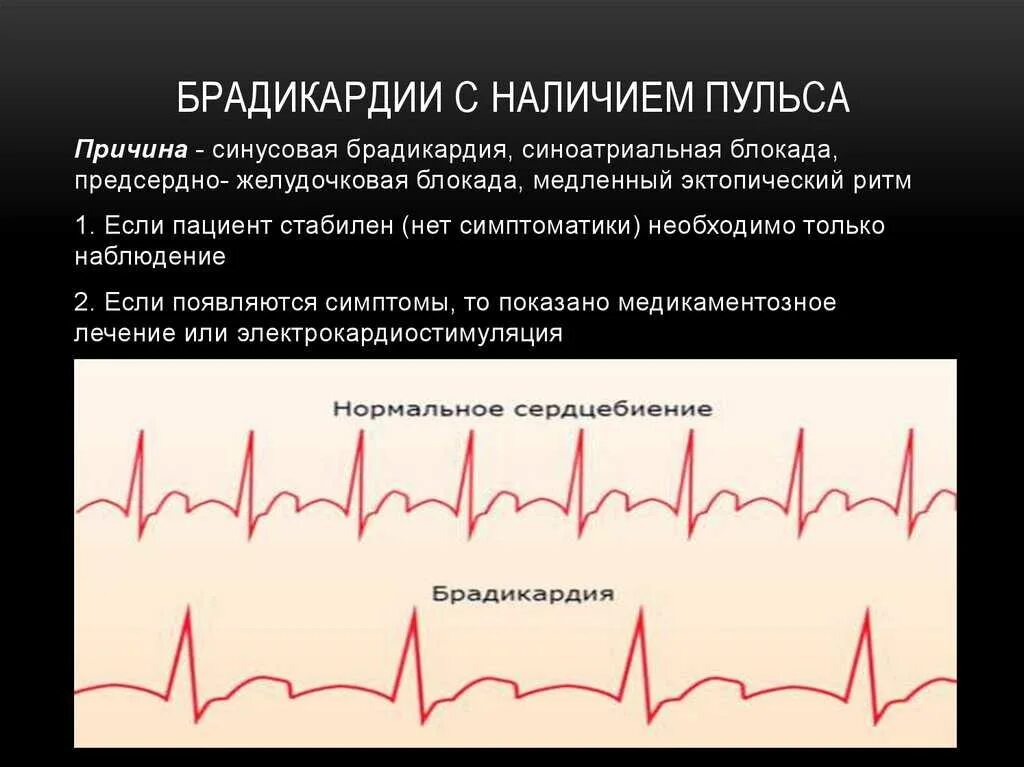 Сильный пульс что делать. Частый и редкий пульс. Заболевания связанные с пульсом. Редкое сердцебиение. ЭКГ при нарушениях ритма сердца.