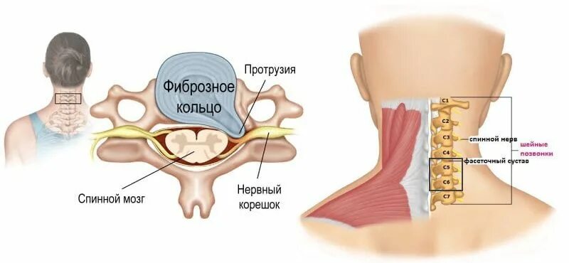 3 4 5 межпозвоночного диска. Протрузии шейного отдела с3-с4 с4-с5 с5-с6. Межпозвонковые диски c5 c6 c7. Протрузия с3-с4 шейного отдела. Протрузии с4-с7 дисков шейного отдела.