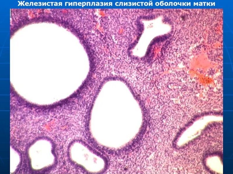 Железистая гиперплазия. Гиперплазия слизистой оболочки матки. Железистая гиперплазия слизистой оболочки матки макропрепарат. Виллезная гиперплазия. Воспаление слизистой оболочки матки