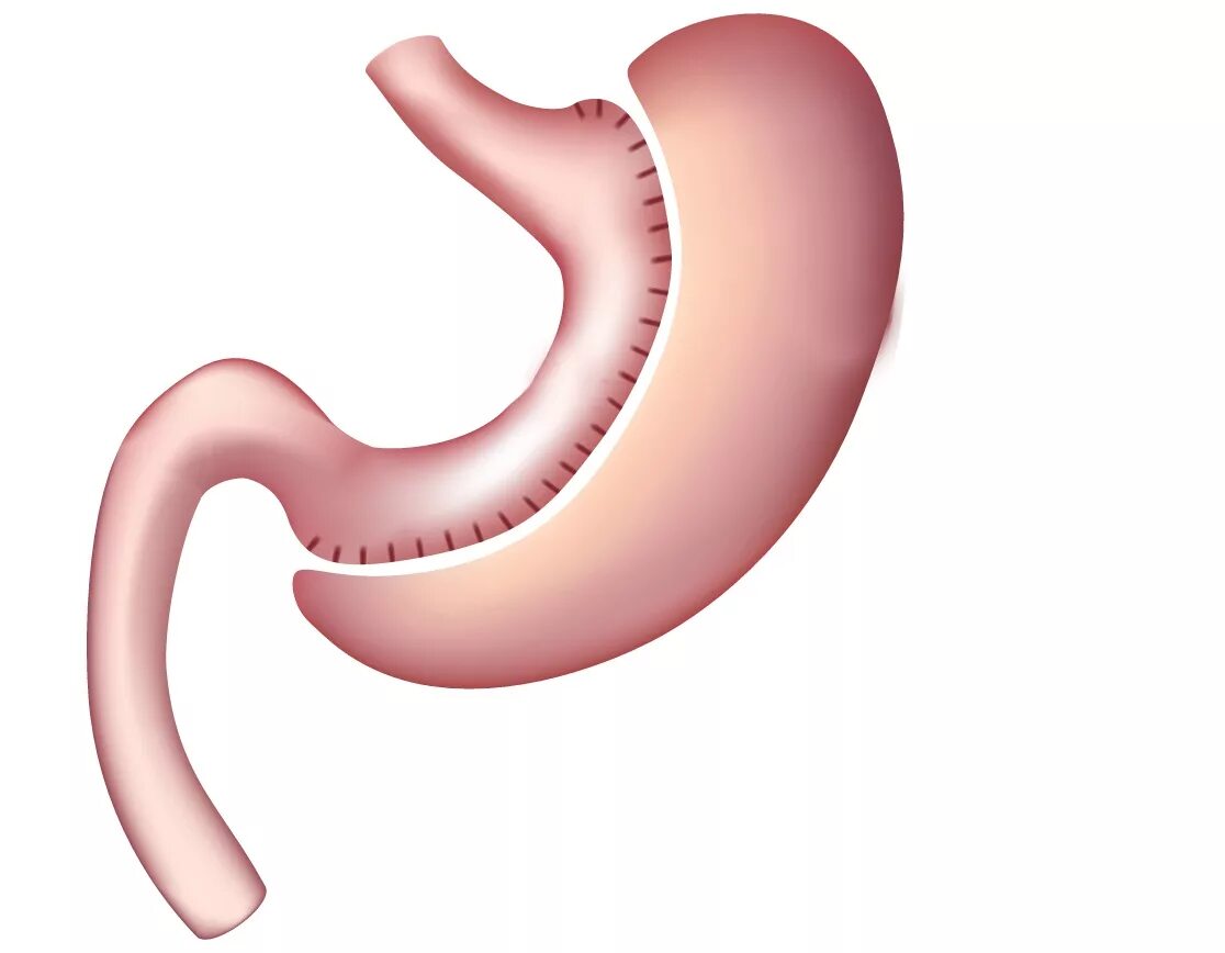 Последствия операции желудка. Продольная резекция желудка схема. Гастропликация лапароскопическая желудка что это. Бариатрия резекция желудка. Лапароскопическая резекция желудка.