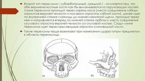 Перелом скуловой кости тесты нмо