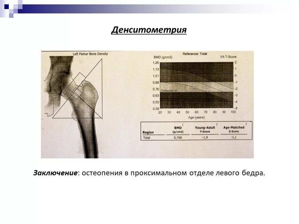 Денситометрия тазобедренных суставов и поясничного отдела позвоночника. Ультразвуковая денситометрия костей. Рентгеновская денситометрия бедренной кости. Рентгеновская остеоденситометрия. Денситометрия костей остеопороз.