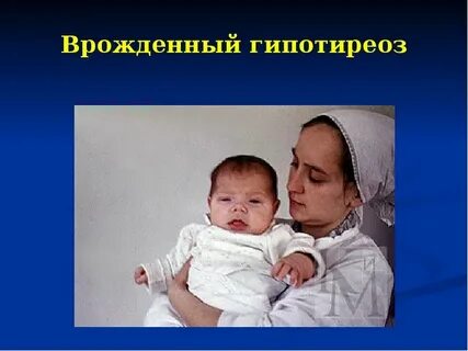 Гипотиреоз у новорожденных симптомы