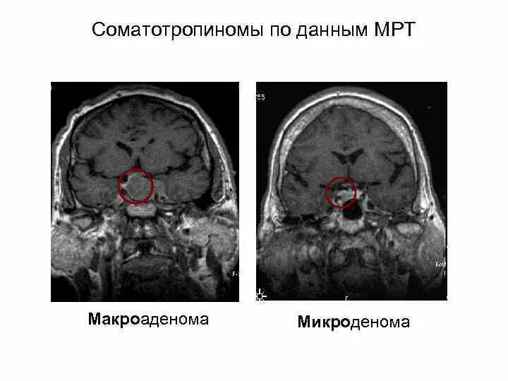 Мрт головного мозга аденома гипофиза. Опухоль аденома гипофиза. Соматотропная аденома гипофиза. Микроаденома гипофиза мрт.