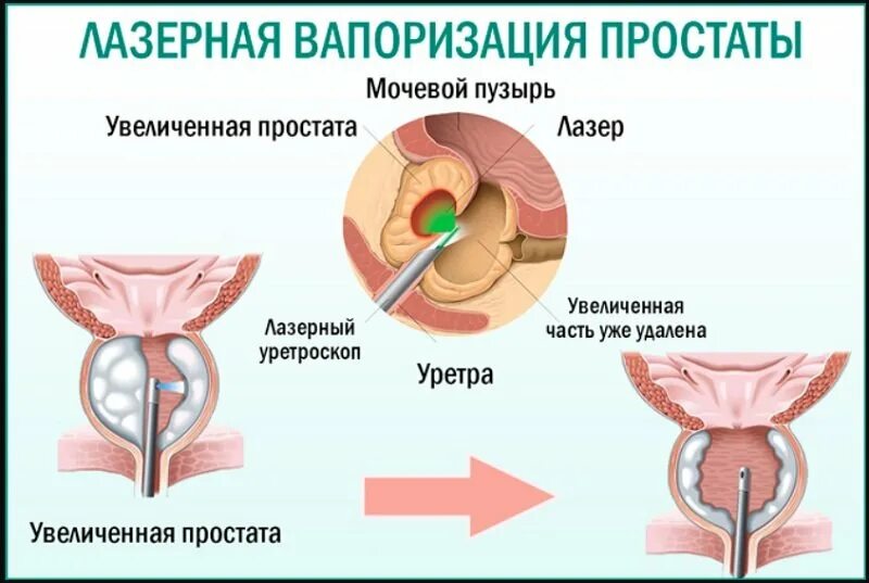 Лазерная вапоризация предстательной железы. Лазерная вапоризация аденомы предстательной железы. Лазерная энуклеация аденомы предстательной железы. Трансуретральная энуклеация простаты лазером. Лазерная вапоризация простаты