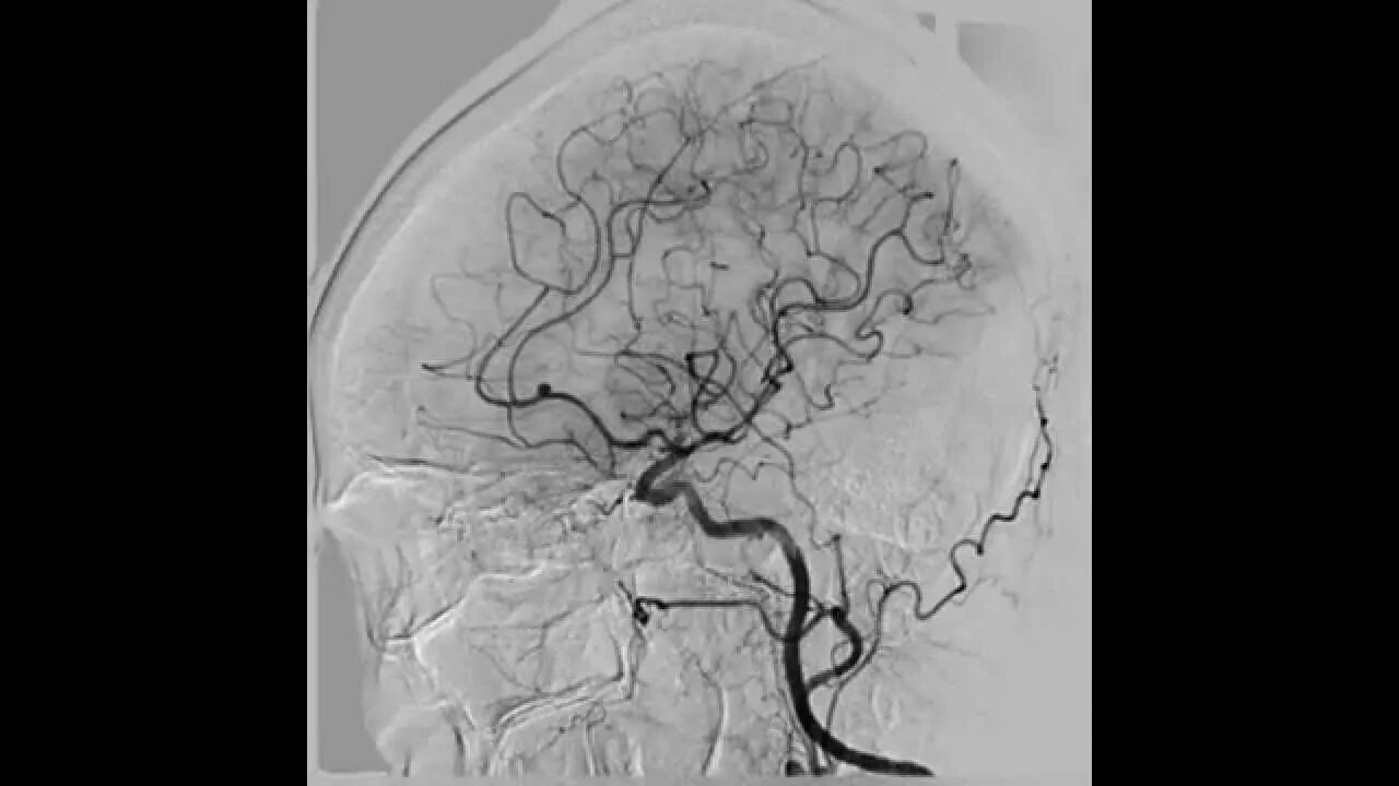 Аневризма в переднемозговой артерии. Мешковидная аневризма головного мозга. Эмболизация аневризмы ВСА. Аневризма передней мозговой артерии головного мозга. Сегмент а1 пма