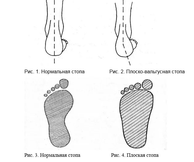 Плоскостопие вальгусная деформация. Плоскостопие плоско вальгусная деформация стоп. Степени плосковальгусной деформации стопы. Уплощения стопы (вальгусной деформации),. Код по мкб 10 вальгусная