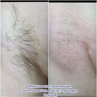 Электроэпиляция на сколько