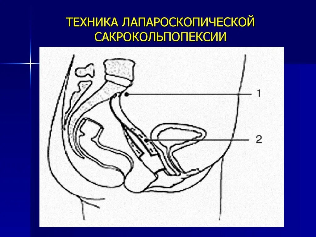 Опущение матки какие операции. Техника лапароскопической сакрокольпопексии. Операции при пролапсе органов малого таза.