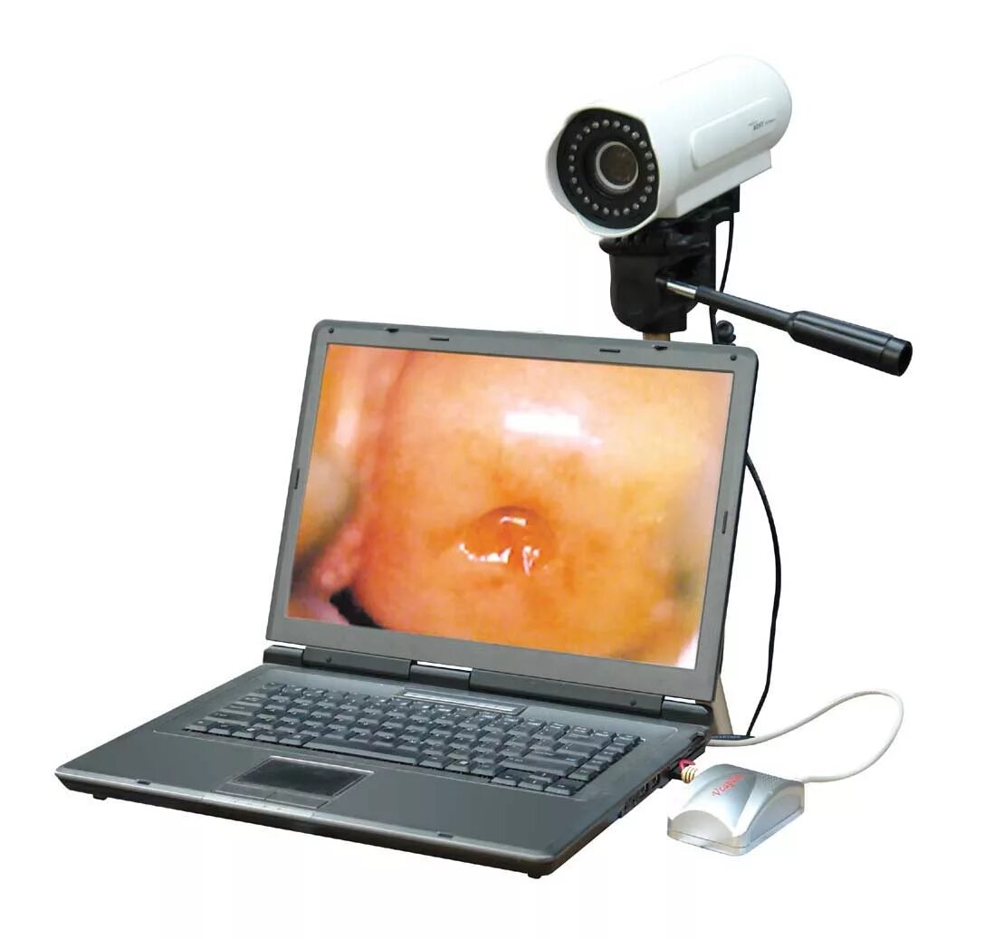 кольпоскопия матки кольпоскопия шейки. кольпоскопия видеокольпоскопия. цифровая кольпоскопия. эрозия кольпоскопия эрозия. кольпоскопия видеокольпоскопия.