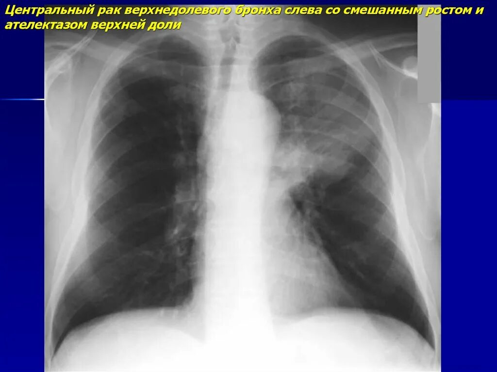 Рак нижней доли. Ателектаз левого легкого рентген. Ателектаз верхней доли рентген. Ателектаз верхней доли левого легкого рентген. Ателектаз верхней доли левого легкого.