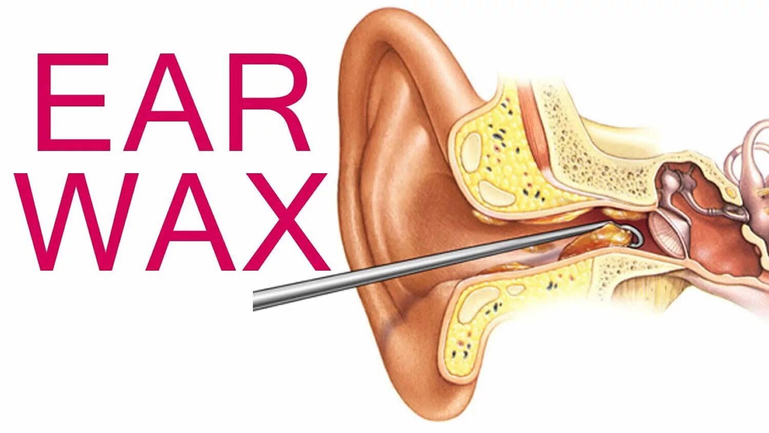 Ушная серная пробка симптомы. Ear wax. Экстрактор ушной. Earwax removal. Чистка ушей от серных пробок.