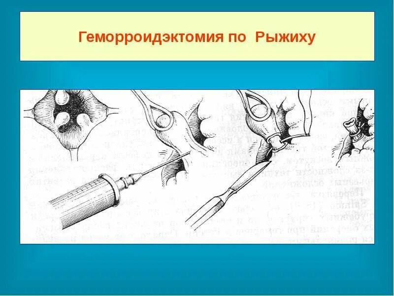 Хирургические заболевания прямой кишки. Геморроидэктомия Миллигана Моргана. Геморроидэктомия миллиган Морган. Операция геморроидэктомия. Миллигану Моргану операция геморроидэктомия.