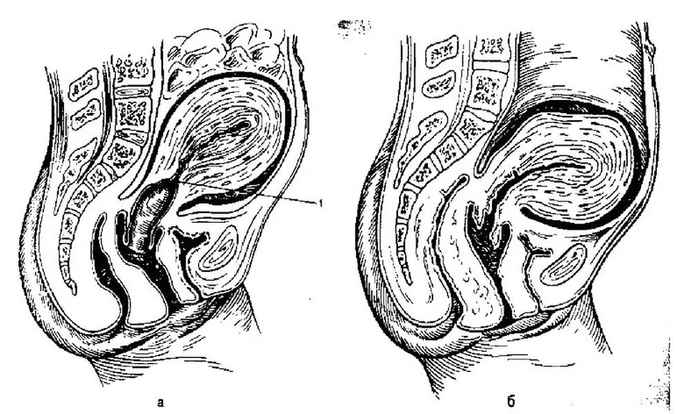 Маточный зев. Изменения в организме родильницы. Матка в послеродовом периоде. Инволюция матки после родов.