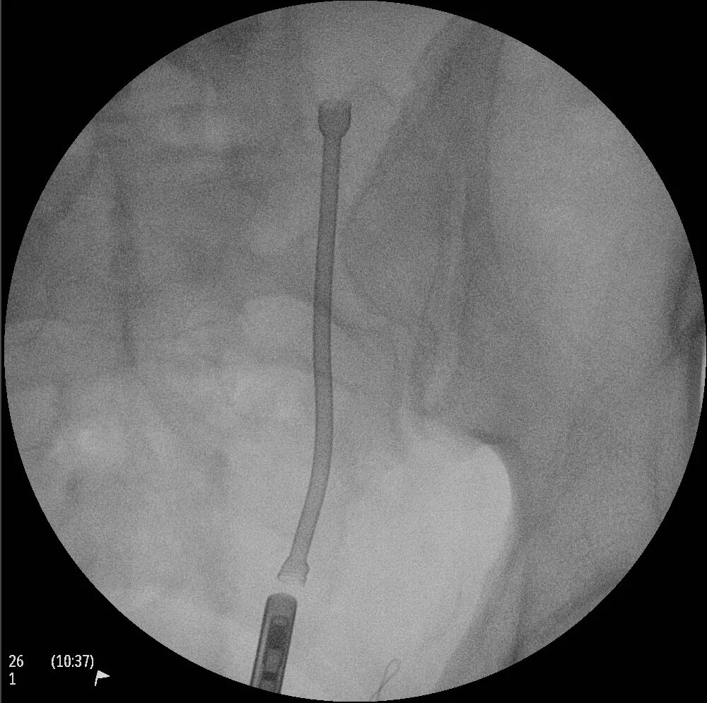 Мочеточник видео. Стент в мочеточнике рентген. Стентирование мочеточника рентген. Камень в мочеточнике стент. Катетер мочеточника рентген.