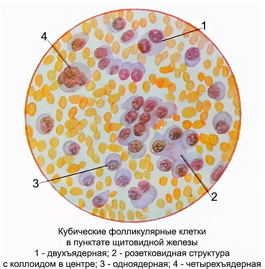 Цитологическое исследование пунктата. Клетки щитовидной железы цитология. Гюртлеклеточная опухоль щитовидной железы цитология. Парафолликулярные клетки щитовидной железы. Пунктат поджелудочной железы цитология.