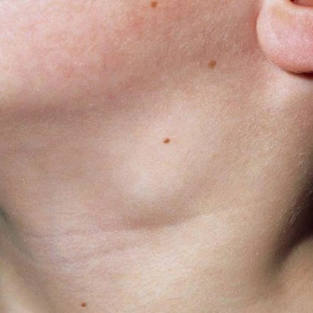 Щека слева. Папулезный милиардный сифилид. Околоушные лимфатические узлы схема. Щека слева. Щека слева.