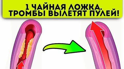 Как чистить тромбы