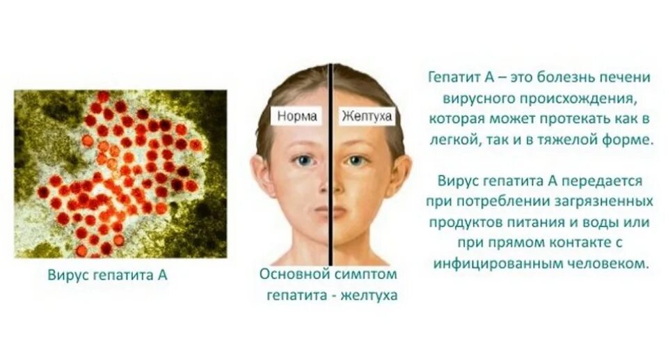 Болезнь вирусный гепатит. Вирусный гепатит симптомы у детей.