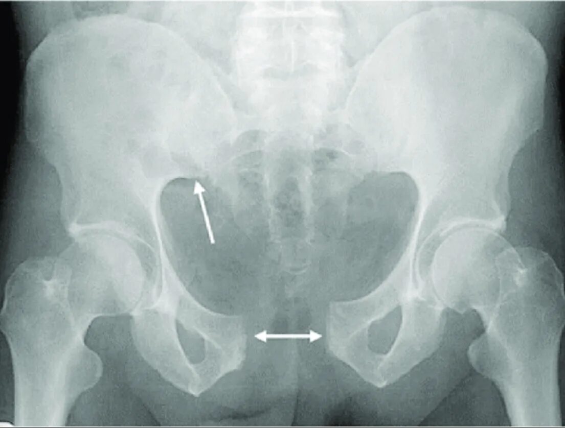 Разрыв кости. Перелом костей копчика рентген. Лонное сочленение рентген. Перелом лобкового симфиза.