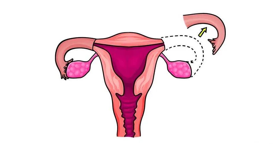 Эктопическая трубная беременность. Эндометриоз и бесплодие. Как забеременеть с одной трубой. Продувание маточных труб. Как забеременеть с одной трубой.