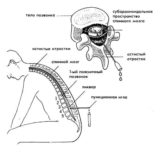 Субарахноидальное пространство спинномозговая жидкость. Анатомия спинного мозга люмбальная пункция. Пункция для исследования спинномозговой жидкости. Люмбальная пункция схема.