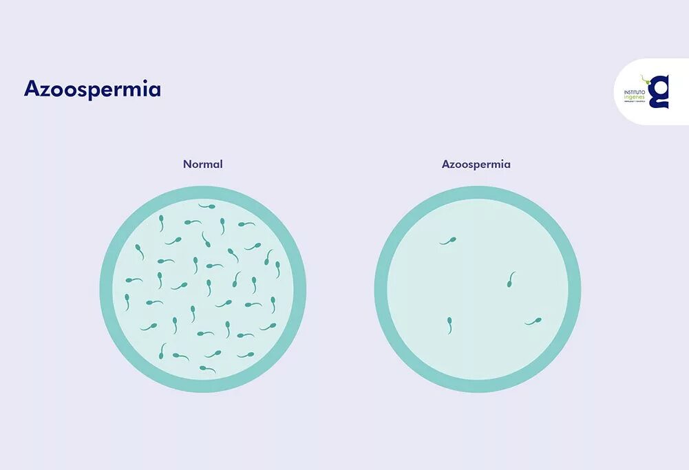 Почему у мужчины густая семенная. Азооспермия. Обструктивная азооспермия. Секреторная азооспермия. Необструктивная азооспермия.