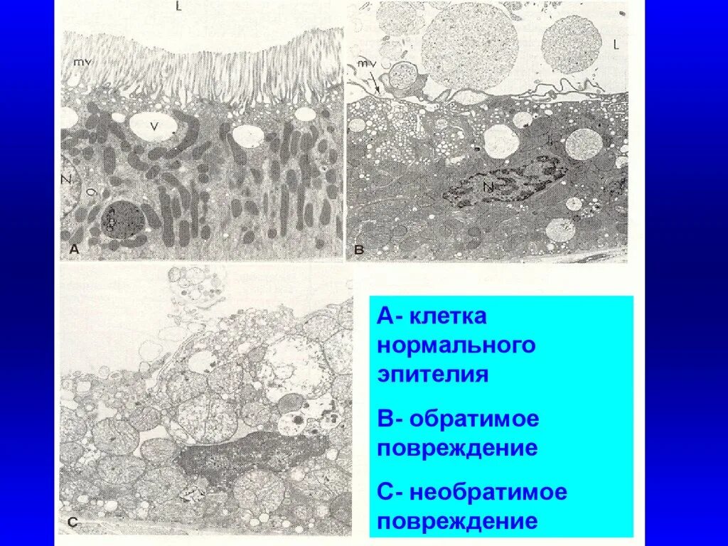 Необратимые повреждения клетки. Обратимые и необратимые повреждения клеток и тканей. Признаки необратимого повреждения клеток. Обратимые и необратимые повреждения клетки патофизиология. Необратимые изменения клетки