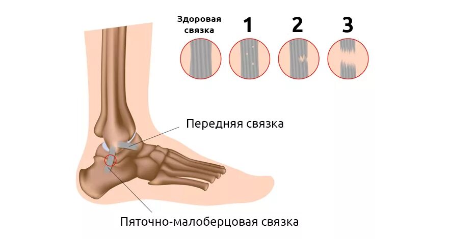 Симптомы растяжения голеностопного. Растяжение связок голеностопа 1 степени. вывих голеностопа степень. растяжение голеностопа 2 степени. степени растяжения голеностопа.