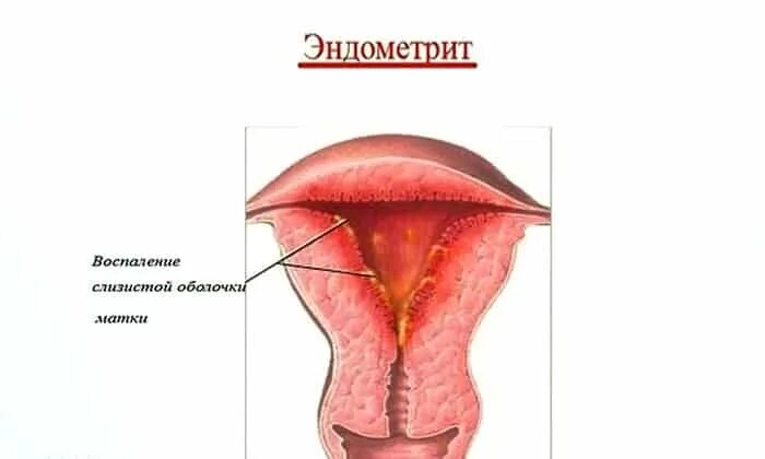Воспаление слизистой оболочки матки