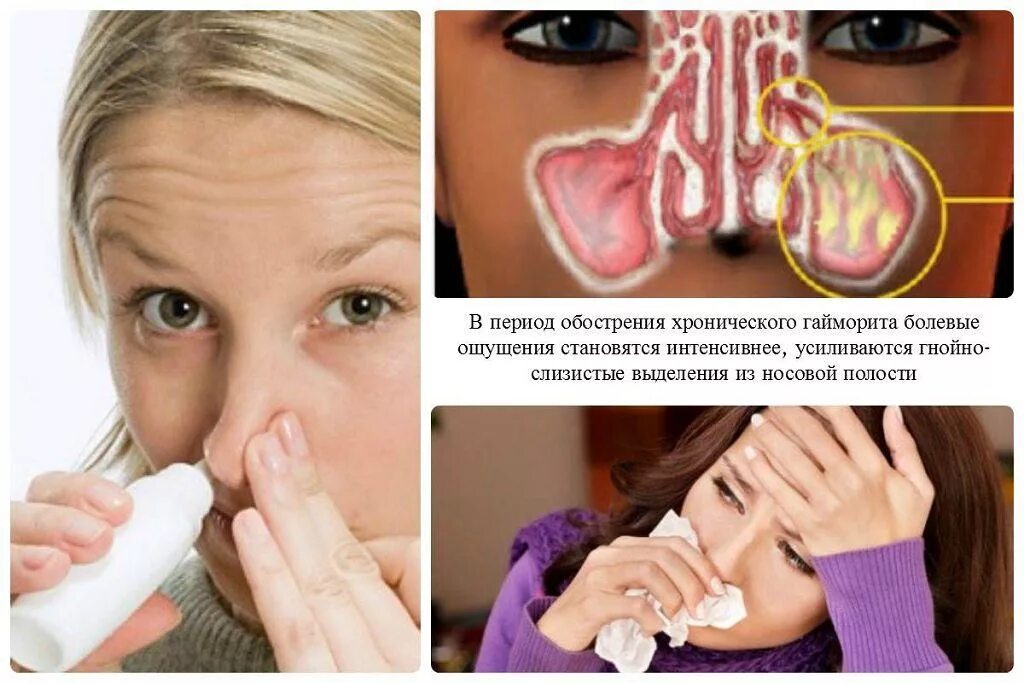 Как быстро снять обострение