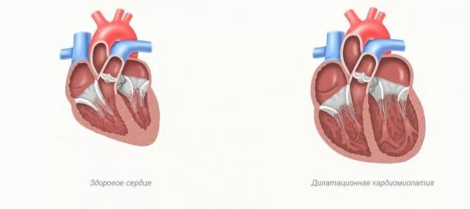 Кардиопатия дилатационная. Левожелудочковая недостаточность и дилатационная кардиомиопатия. Кардиопатия дилатационная кардиомиопатия. Дилатационная кардиомиопатия собак. Расширения сердца правой