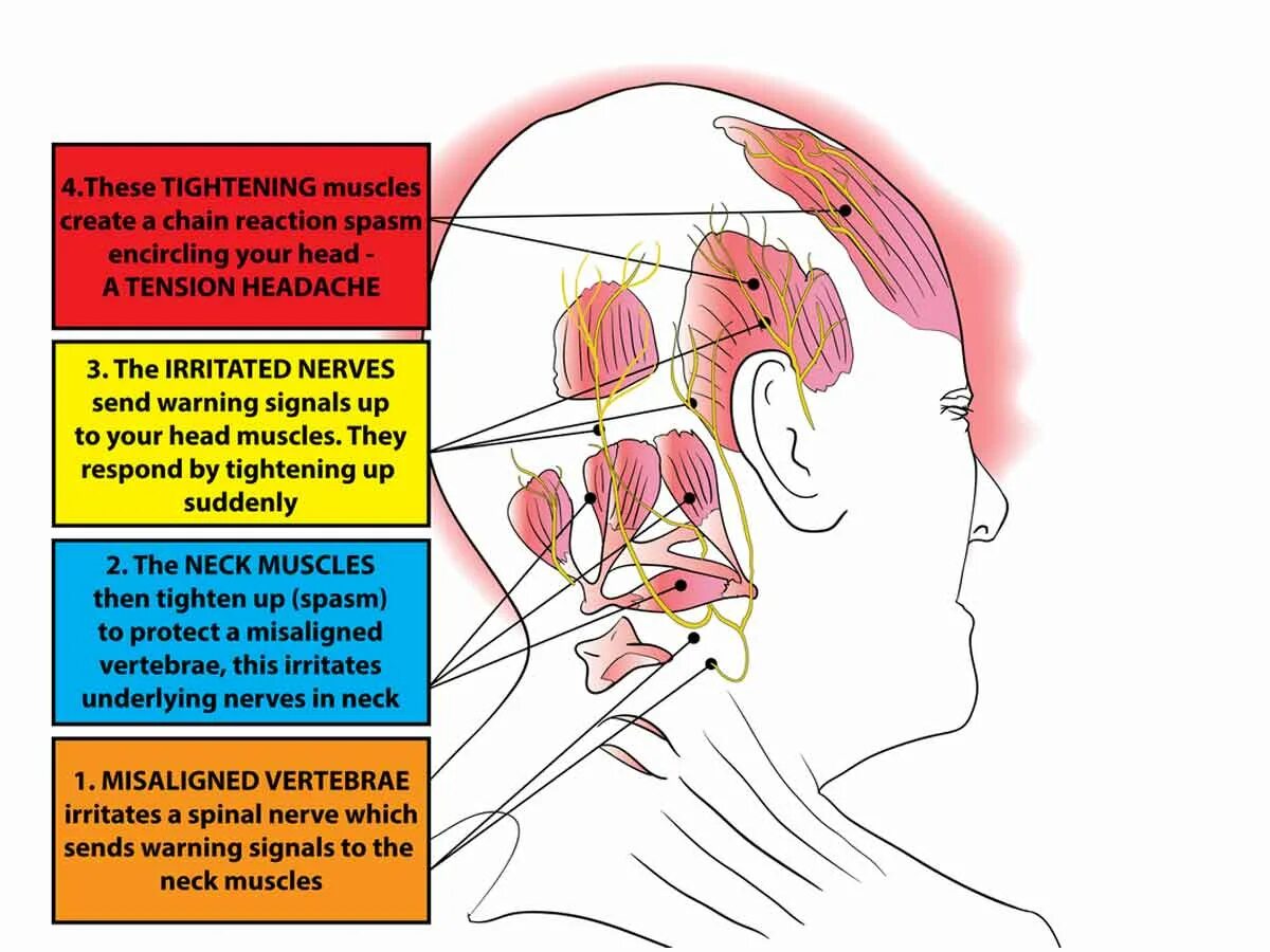 Нейропатия затылочного нерва. Боли в ооловн. Боль в голове. Болит затылок справа. Болит голова справа за ухом.