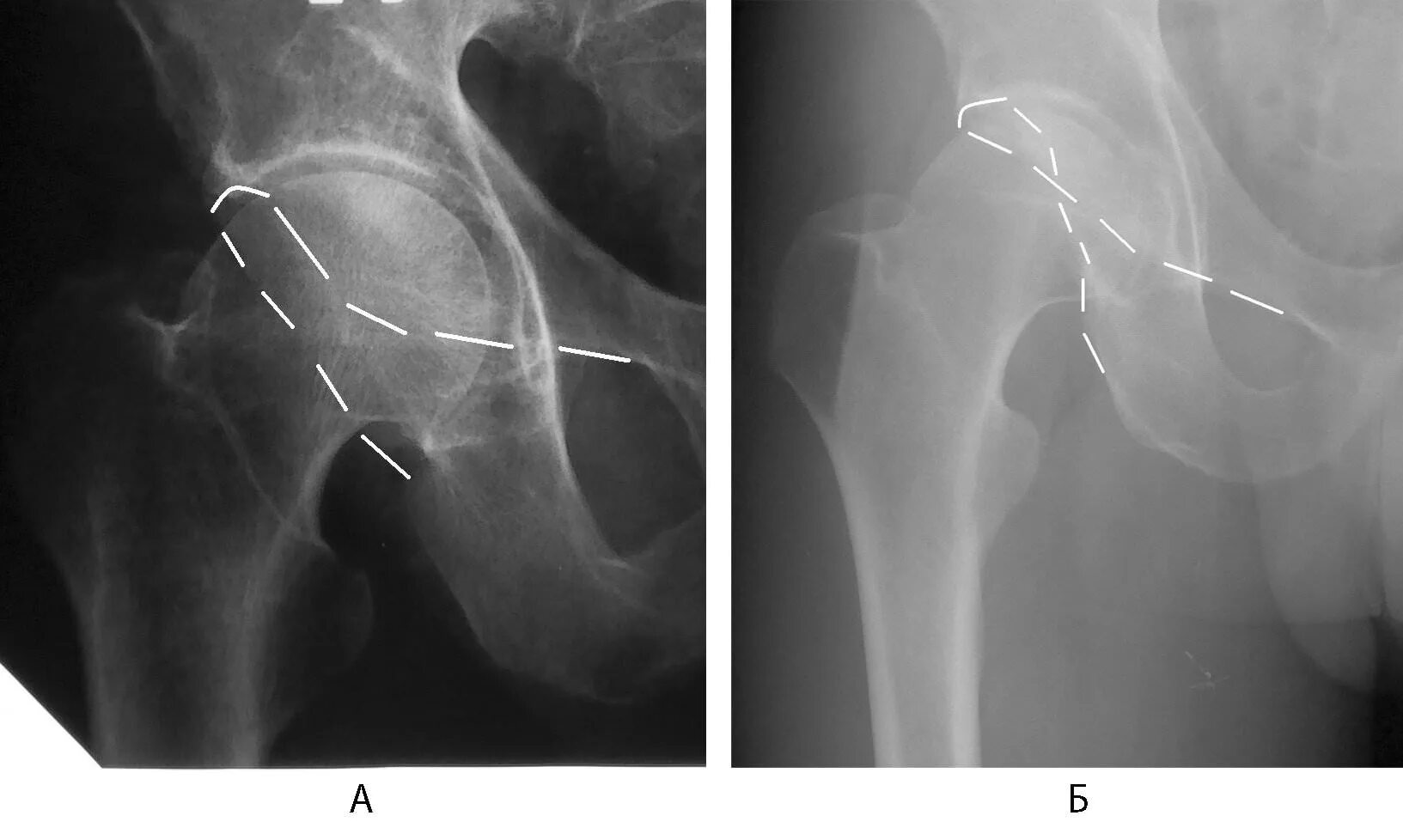 Перелом шейки тазобедренного сустава рентген. Тазобедренный перелом шейки бедра. Перелом бедренной кости в тазобедренном суставе. Оссификаты вертлужной впадины. Трещина шейки бедра